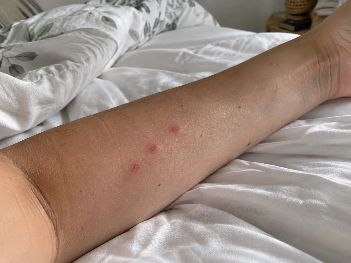 Bites lined up in threes or fours when you wake up: identification photo (bed bugs)